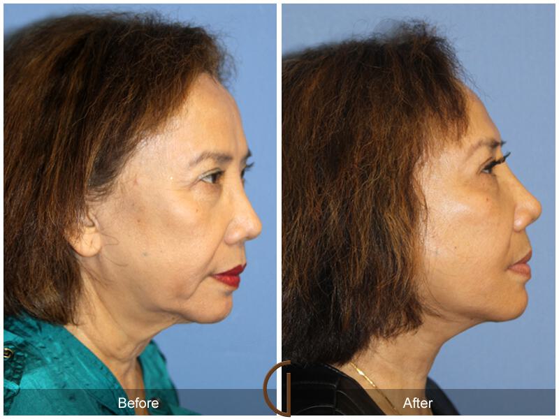 Facelift Sixties Before & After Photo