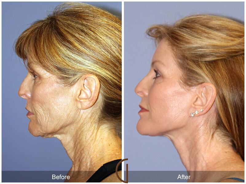 Facelift Sixties Before & After Photo