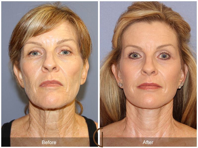 Facelift Sixties Before & After Photo