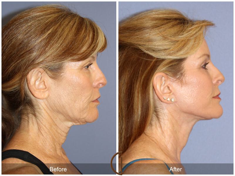 Facelift Sixties Before & After Photo