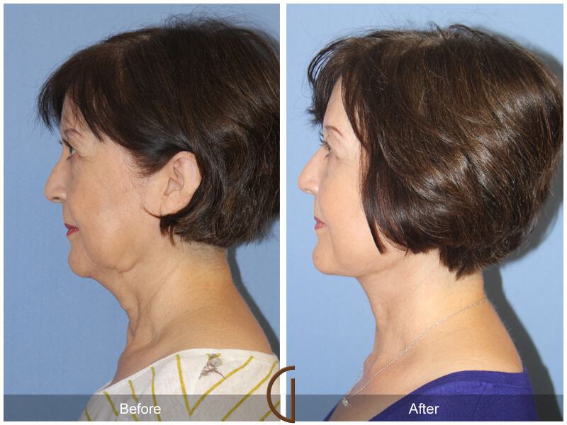 Facelift Sixties Before & After Photo