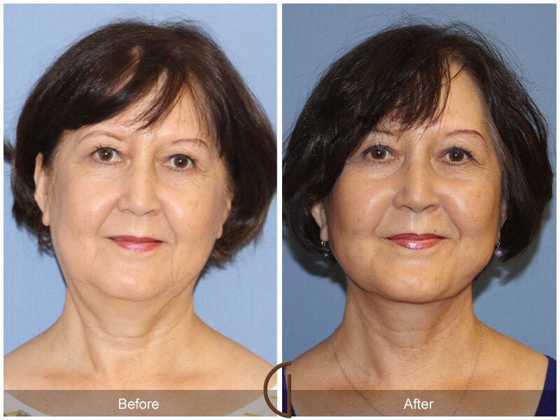 Facelift Sixties Before & After Photo