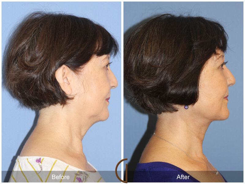 Facelift Sixties Before & After Photo