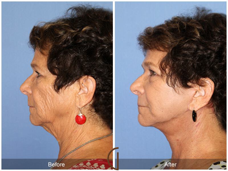 Facelift Sixties Before & After Photo