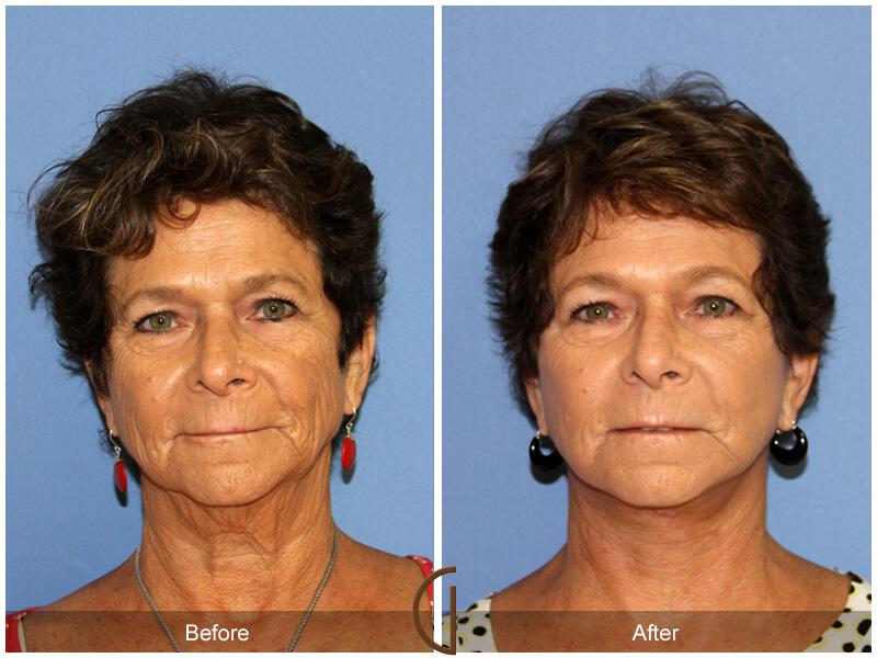 Facelift Sixties Before & After Photo