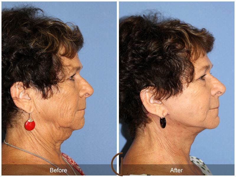 Facelift Sixties Before & After Photo