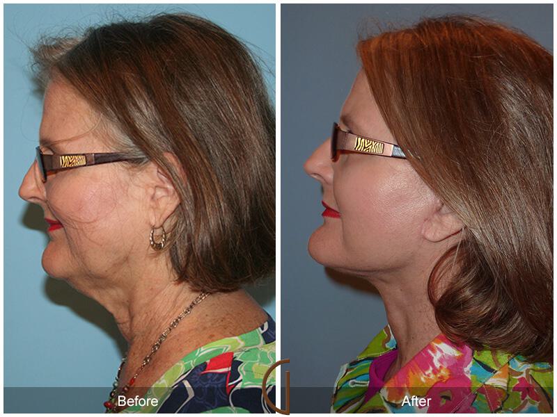 Facelift Sixties Before & After Photo