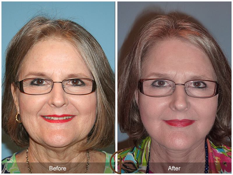 Facelift Sixties Before & After Photo