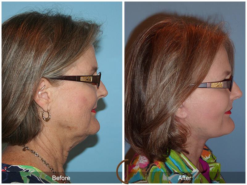 Facelift Sixties Before & After Photo