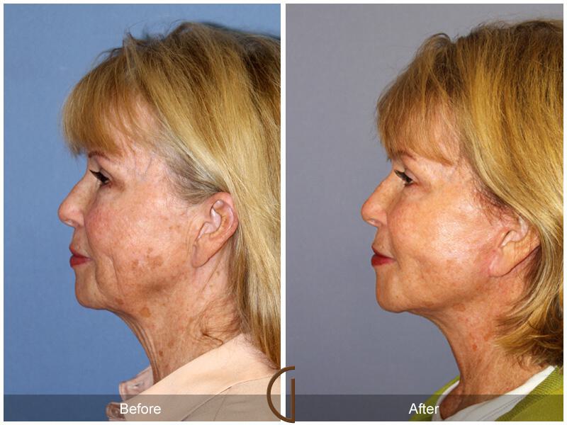 Facelift Sixties Before & After Photo