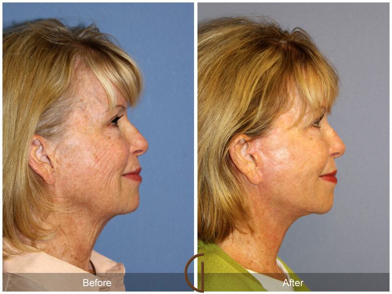 Facelift Sixties Before & After Photo