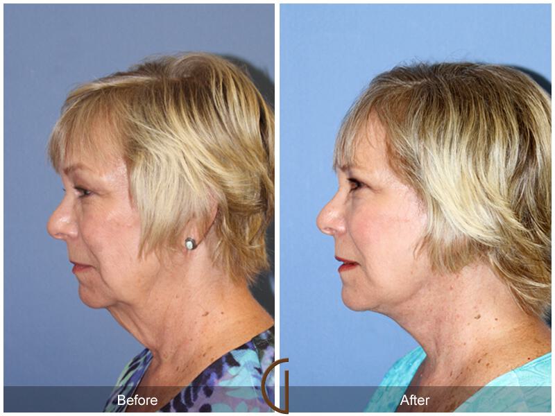 Facelift Sixties Before & After Photo