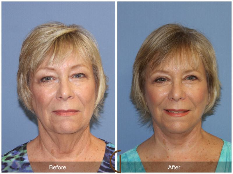 Facelift Sixties Before & After Photo