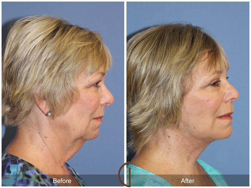 Facelift Sixties Before & After Photo