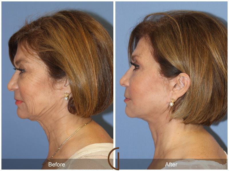 Facelift Sixties Before & After Photo