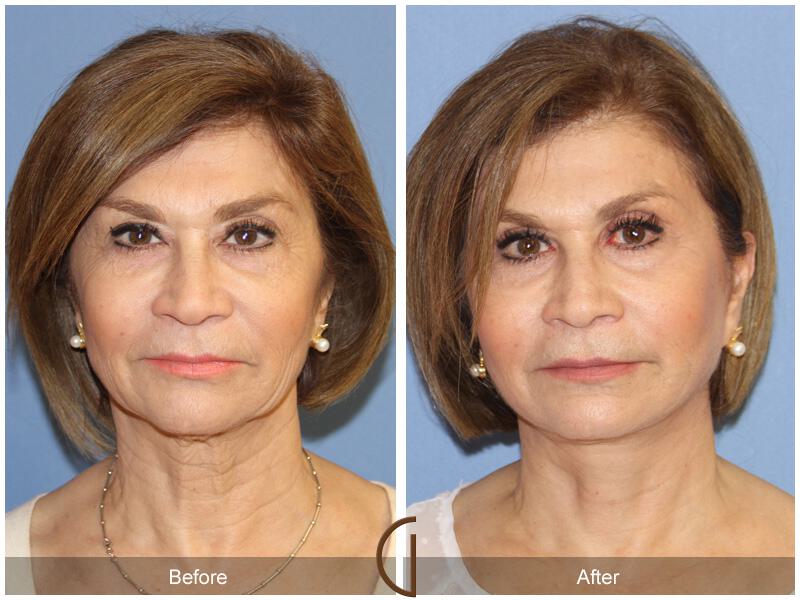 Facelift Sixties Before & After Photo