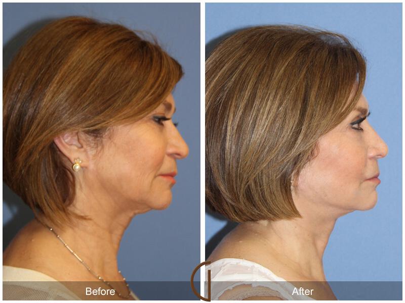 Facelift Sixties Before & After Photo