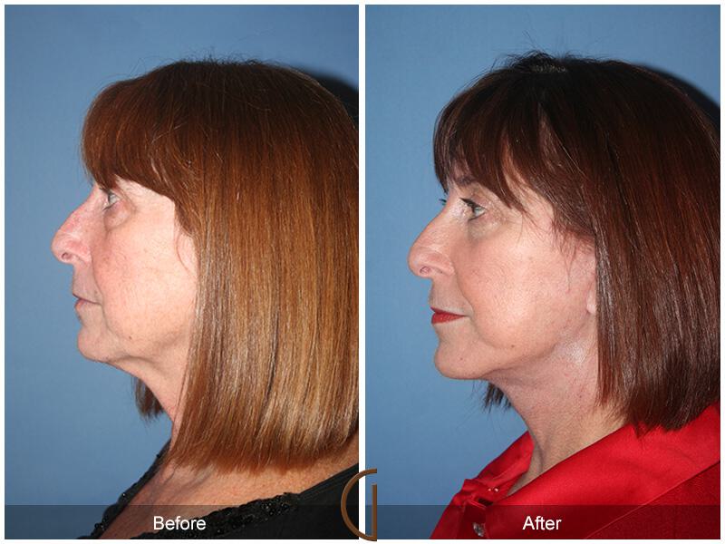 Facelift Sixties Before & After Photo