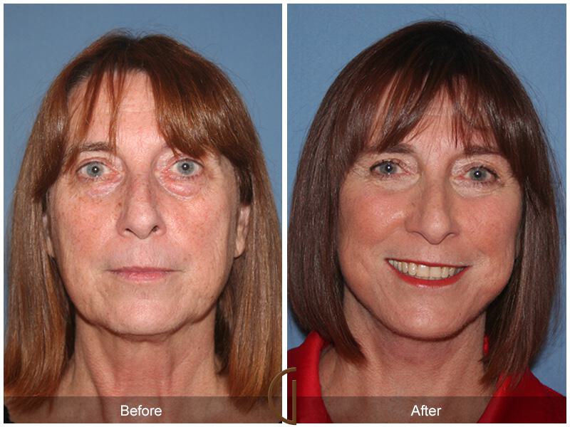 Facelift Sixties Before & After Photo