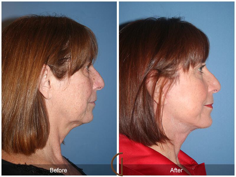 Facelift Sixties Before & After Photo