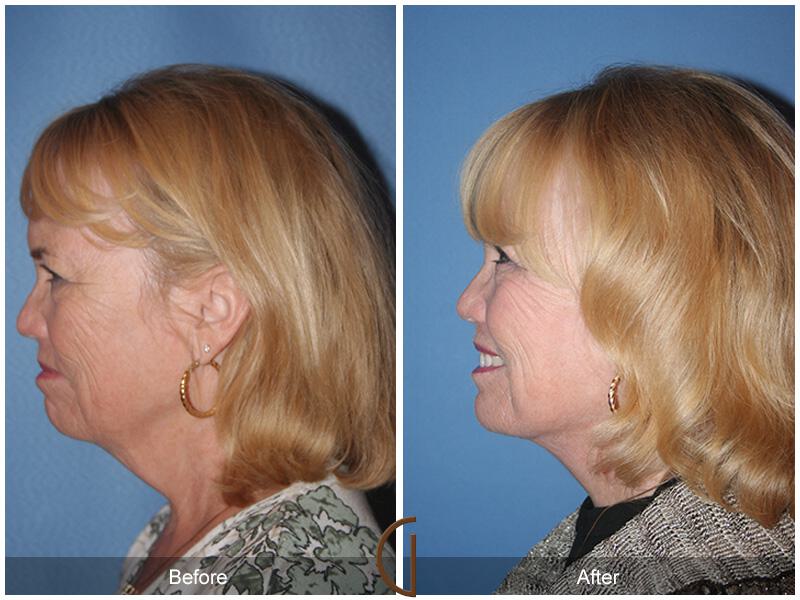 Facelift Sixties Before & After Photo