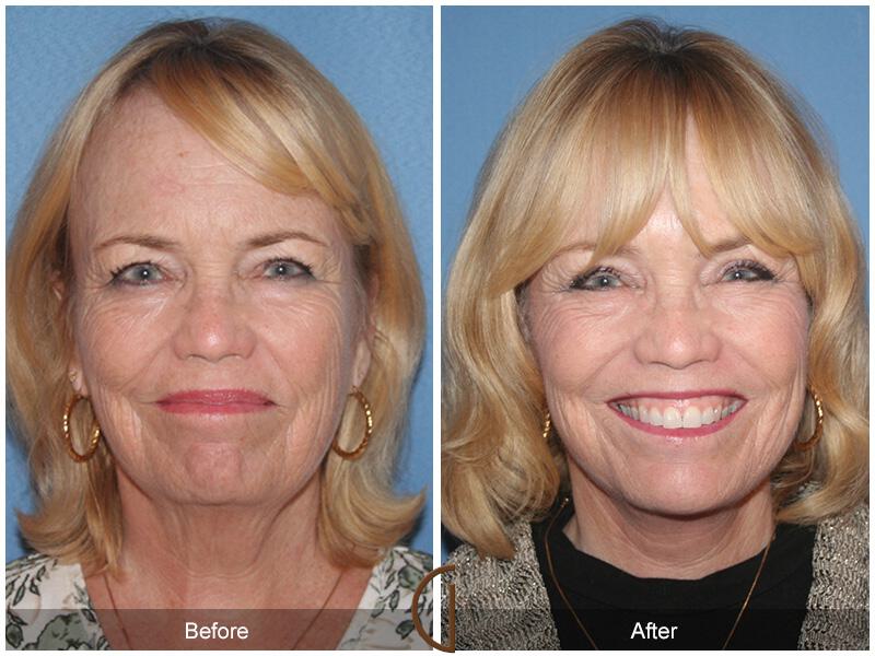 Facelift Sixties Before & After Photo