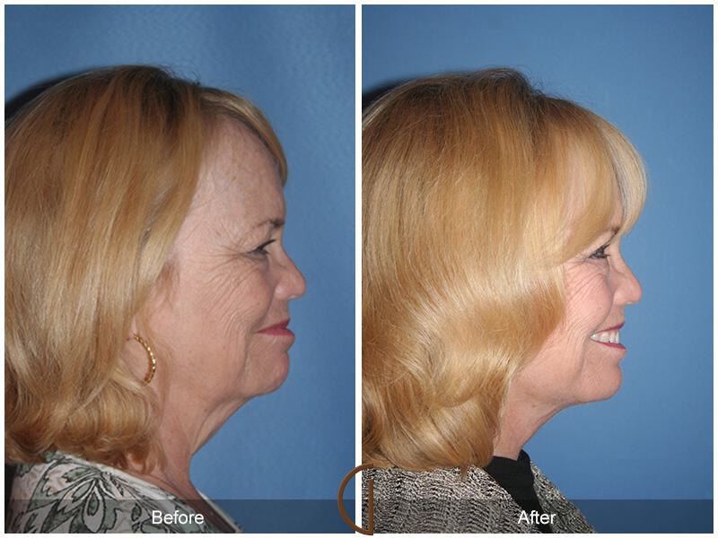 Facelift Sixties Before & After Photo