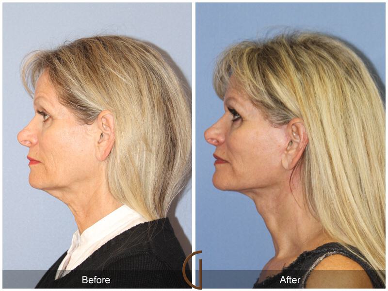 Facelift Sixties Before & After Photo