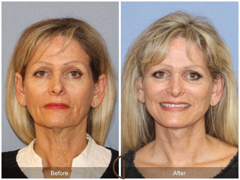 Facelift Sixties Before & After Photo