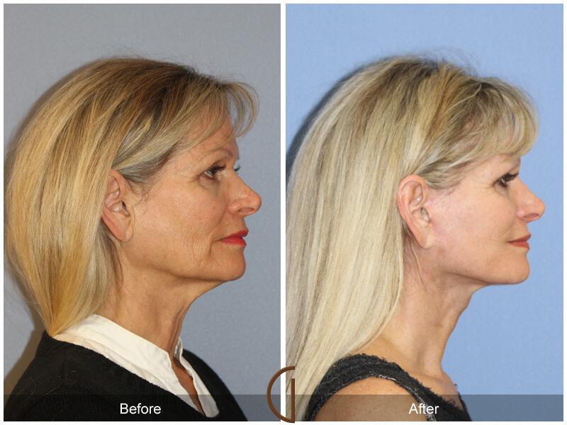 Facelift Sixties Before & After Photo