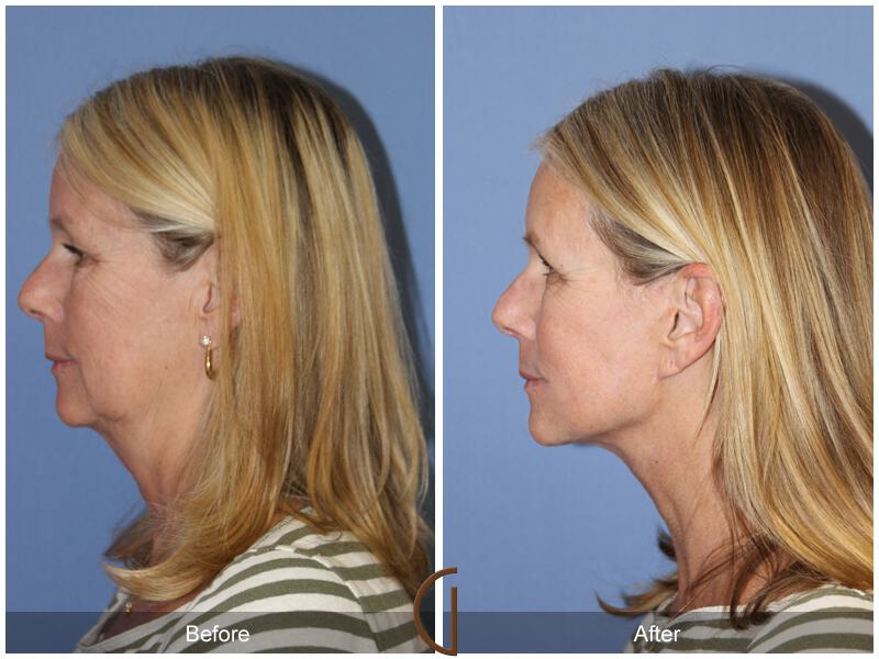 Facelift Sixties Before & After Photo