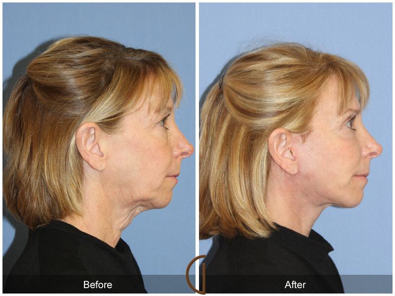 Facelift Sixties Before & After Photo