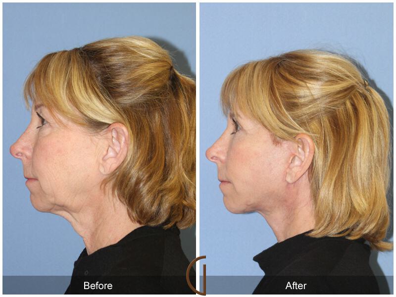 Facelift Sixties Before & After Photo