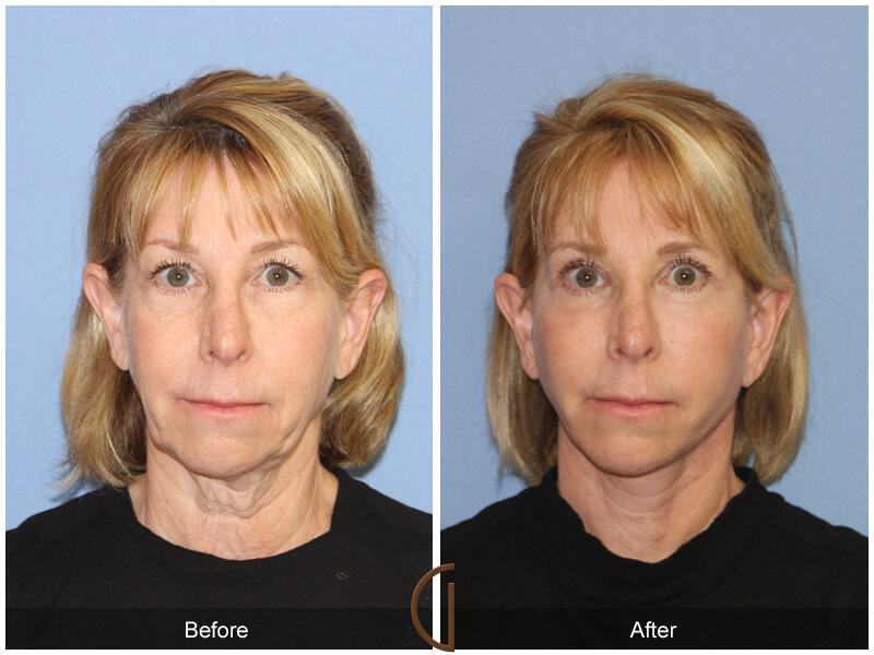 Facelift Sixties Before & After Photo