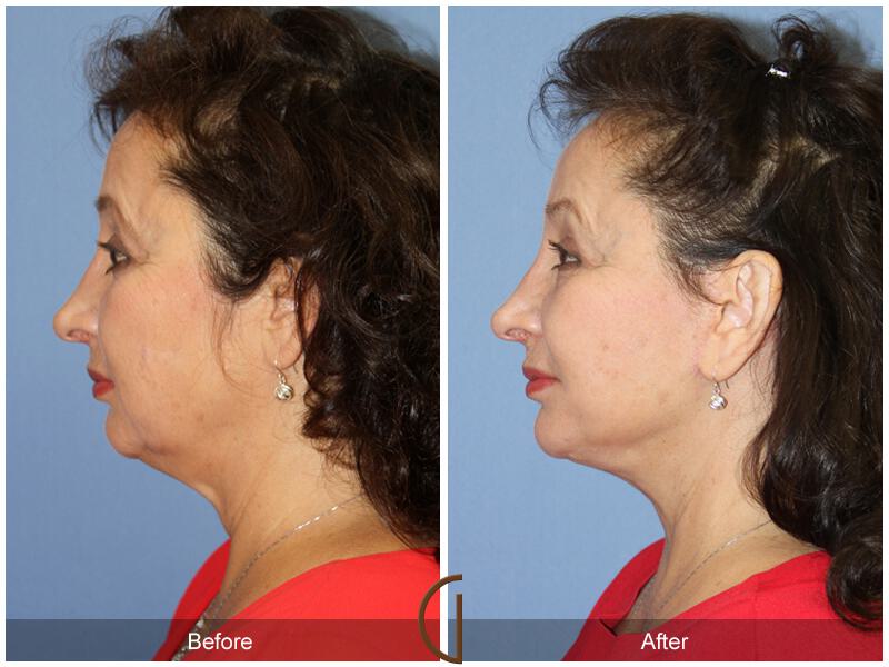 Facelift Sixties Before & After Photo