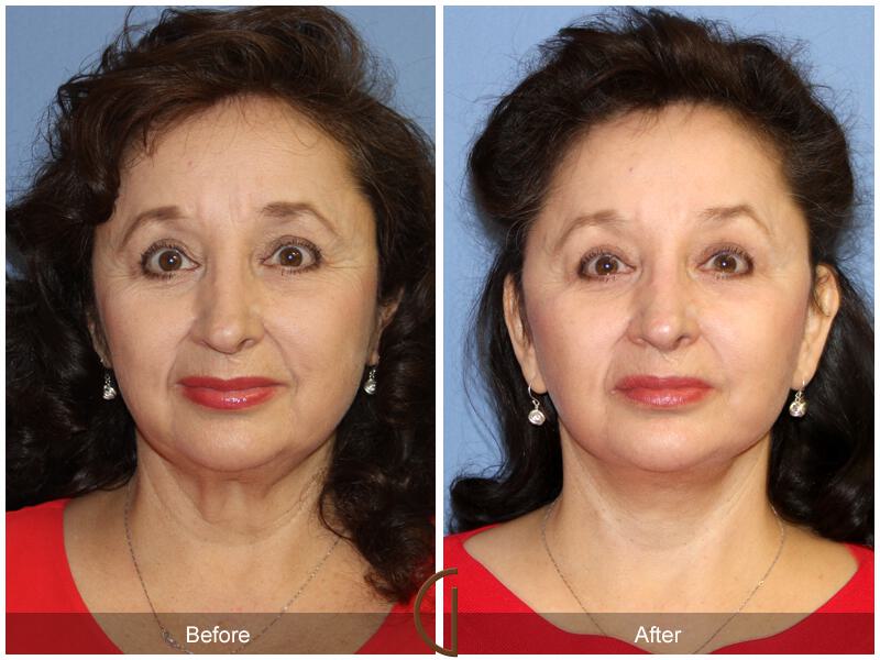 Facelift Sixties Before & After Photo