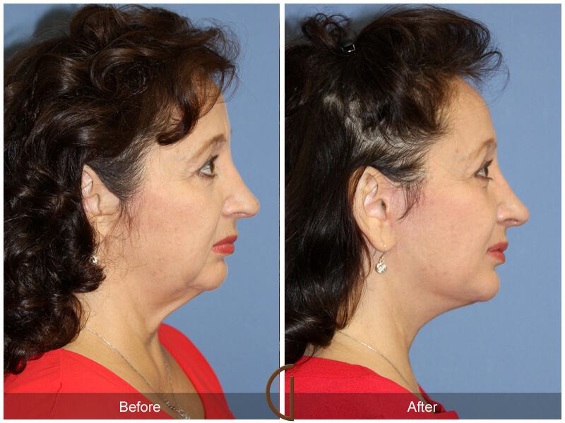 Facelift Sixties Before & After Photo