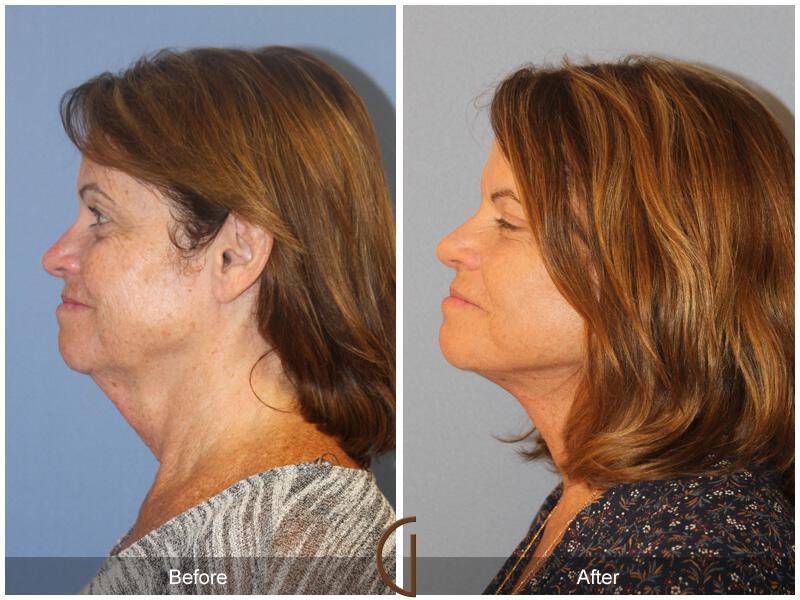 Facelift Sixties Before & After Photo