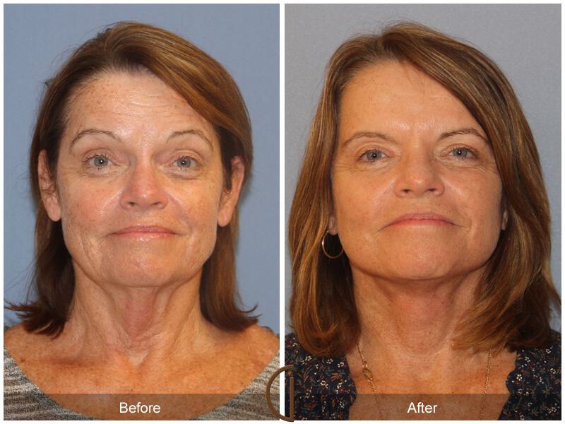 Facelift Sixties Before & After Photo