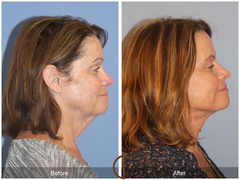 Facelift Sixties Before & After Photo