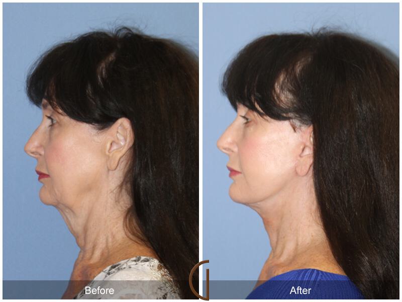 Facelift Sixties Before & After Photo