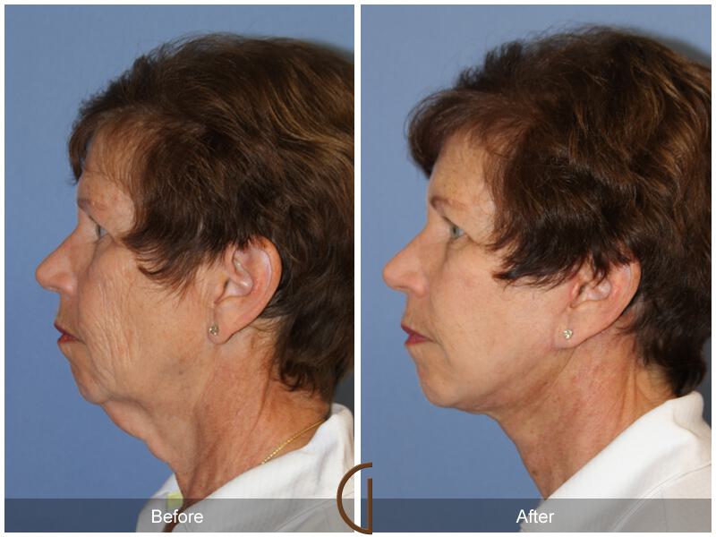 Facelift Sixties Before & After Photo