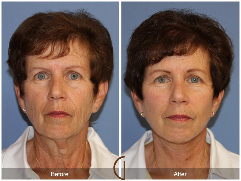 Facelift Sixties Before & After Photo