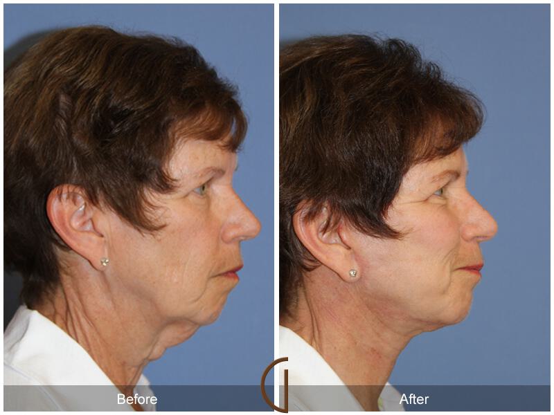 Facelift Sixties Before & After Photo