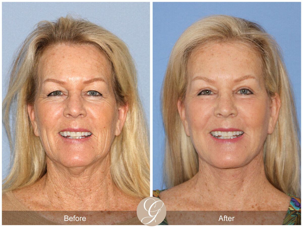 Facelift Sixties Before & After Photo