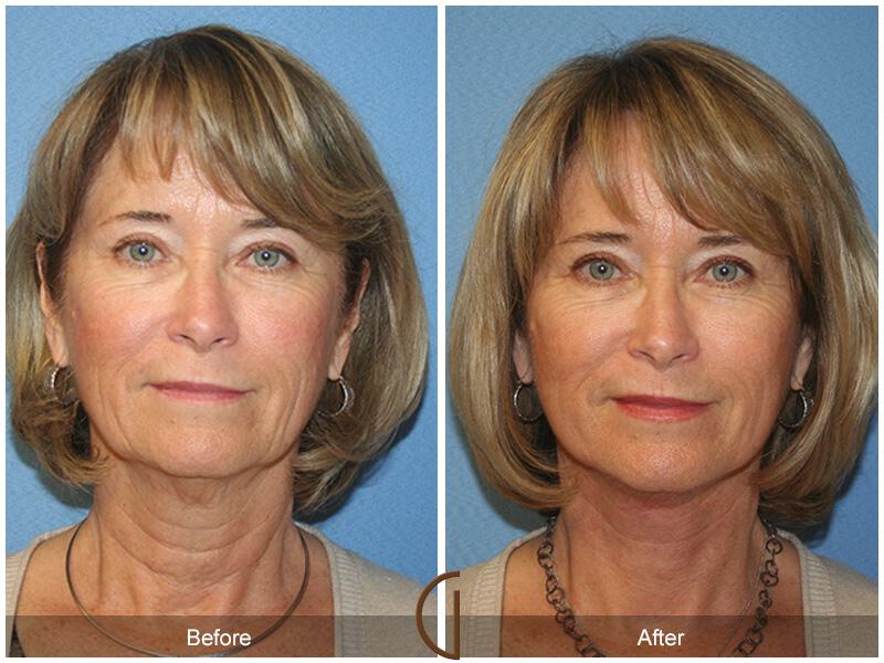 Facelift Sixties Before & After Photo