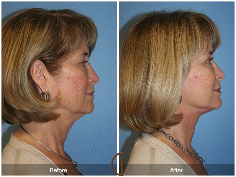 Facelift Sixties Before & After Photo