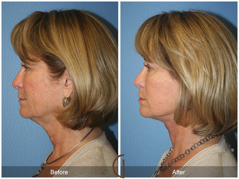 Facelift Sixties Before & After Photo