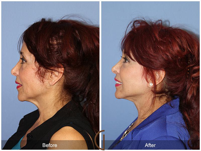 Facelift Sixties Before & After Photo