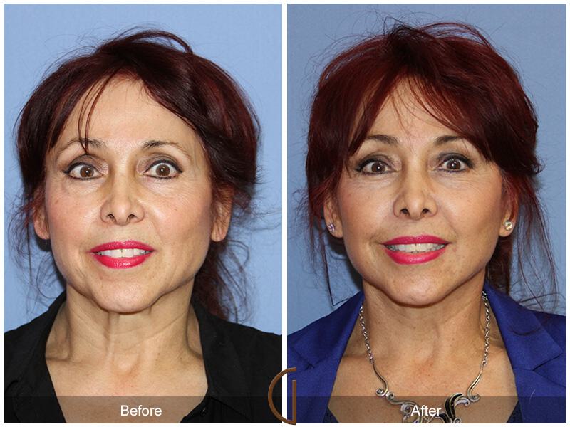 Facelift Sixties Before & After Photo